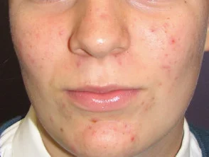 acne-face_8_3