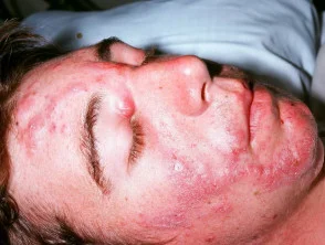 acne in het gezicht