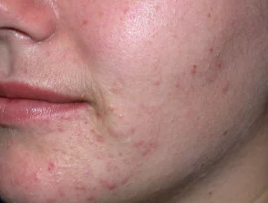 acne in het gezicht