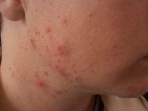 acne in het gezicht