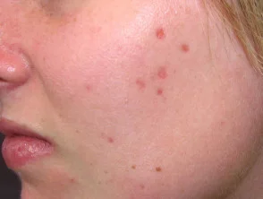 Acne: roze vlekken