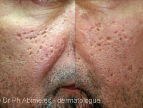 Cicatrices de acné