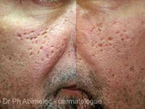 acne littekens