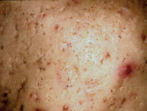Cicatrices de acné picahielos