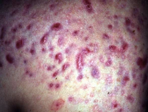 acne littekens