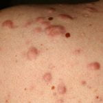 acne-scar5__protectwyjqcm90zwn0il0_focusfillwzi5ncwymjisingildfd-5273279-6568497-jpg-9436993