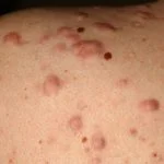 acne-scar5__protectwyjqcm90zwn0il0_focusfillwzi5ncwymjisingildfd-5273279-6568497-jpg-9436993