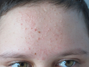 Acne dovuta a steroidi sistemici