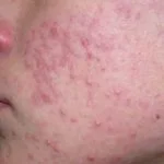 acne1__protectwyjqcm90zwn0il0_focusfillwzi5ncwymjisingildfd-9908694-6312683-jpg-6927454