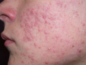 veel voorkomende acne