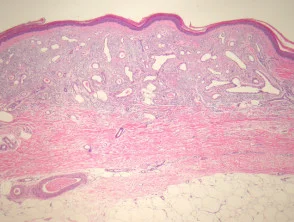 Verworven pathologie van elastotisch hemangioom