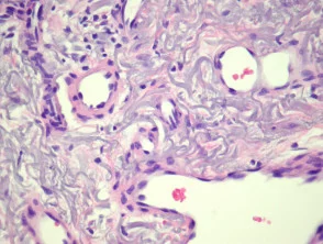 Verworven pathologie van elastotisch hemangioom