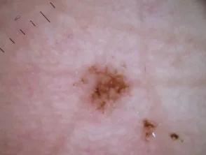 Acral lentigineus melanoom dermatoscopie