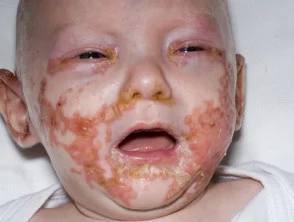 acrodermatitis enteropathica