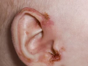 acrodermatitis enteropathica