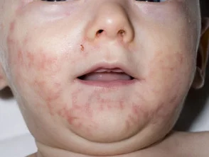 acrodermatitis enteropathica