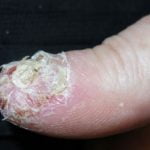 acropustulosis-03__protectwyjqcm90zwn0il0_focusfillwzi5ncwymjisingildfd-1525105-4485458-jpg-9818174