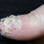 Akropustulose-03__protectwyjqcm90zwn0il0_focusfillwzi5ncwymjisingildfd-1525105-4485458-jpg-9818174
