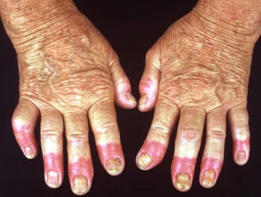 Hallopeau acrodermatitis continua