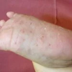 acropustulosis1__protectwyjqcm90zwn0il0_focusfillwzi5ncwymjisingildfd-1723132-2439520-jpg-3951410
