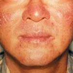 act-derm1__protectwyjqcm90zwn0il0_focusfillwzi5ncwymjisingildfd-1973831-6494905-jpg-2019596