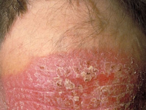 Dermatitis actínica crónica