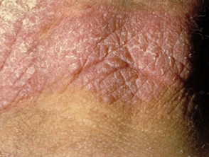 Dermatitis actínica crónica