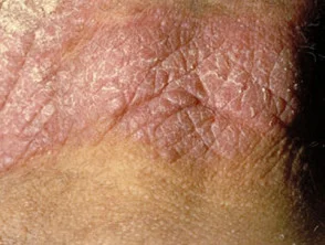 Chronische aktinische Dermatitis