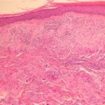 Actinic-Granuloma-Figure-1__protectwyjqcm90zwn0il0_focusfillwzi5ncwymjisingildfd-3257194-1379907-jpg-3929181