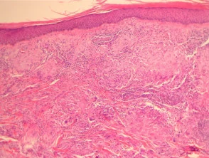 Actinische granuloompathologie