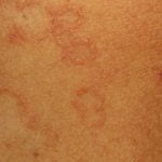 actinic-granuloma1__protectwyjqcm90zwn0il0_focusfillwzi5ncwymjisingildfd-8960902-5826820-jpg-8462185