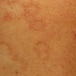 Aktinisches Granulom1__protectwyjqcm90zwn0il0_focusfillwzi5ncwymjisingildfd-8960902-5826820-jpg-8462185