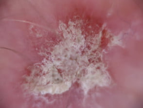 Dermatoscopia de queratosis actínica