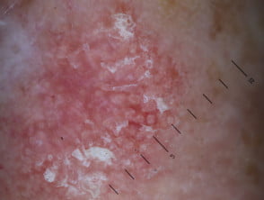 Dermatoscopia de queratosis actínica