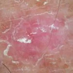 actinic-keratosis-dermoscopy8__protectwyjqcm90zwn0il0_focusfillwzi5ncwymjisingildfd-7488071-6150994-jpg-8366743