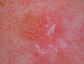 Dermatoscopia de queratosis actínica