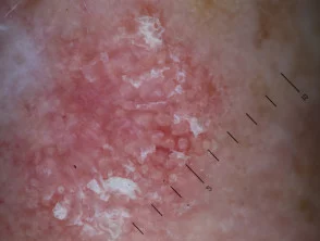 Queratosis actínica que afecta a la cara.