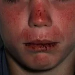actinic-prurigo1__protectwyjqcm90zwn0il0_focusfillwzi5ncwymjisingildfd-8383488-6555123-jpg-4332873