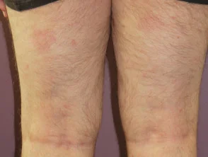 Psoriasis 6 maanden na het starten met adalimumab