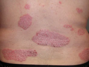 Psoriasis vor Beginn der Einnahme von Adalimumab