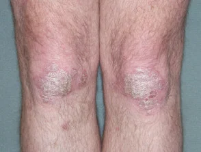 Psoriasis voordat u met adalimumab begint