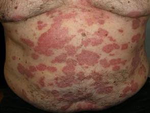 Psoriasis vor Beginn der Einnahme von Adalimumab