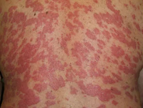 Psoriasis vor Beginn der Einnahme von Adalimumab