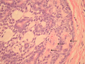 Adenoide zystische Karzinompathologie