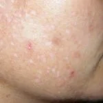 adult-acne1__protectwyjqcm90zwn0il0_focusfillwzi5ncwymjisingildfd-2508885-1450421-jpg-2789951