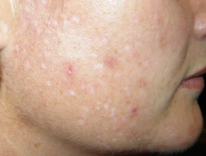 volwassen-acne1__protectwyjqcm90zwn0il0_focusfillwzi5ncwymjisingildfd-2508885-1450421-jpg-2789951