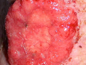 Carcinoma de células basales avanzado