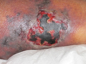 Herida infectada por Aeromonas hydrophila que causa celulitis necrotizante