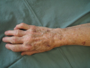 Envejecimiento de la piel