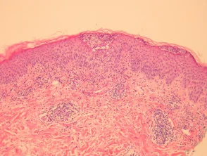 Patología de la pustulosis exantematosa generalizada aguda (AGEP) 